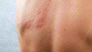 Best home remedies to soothe herpes skin rashes naturally
